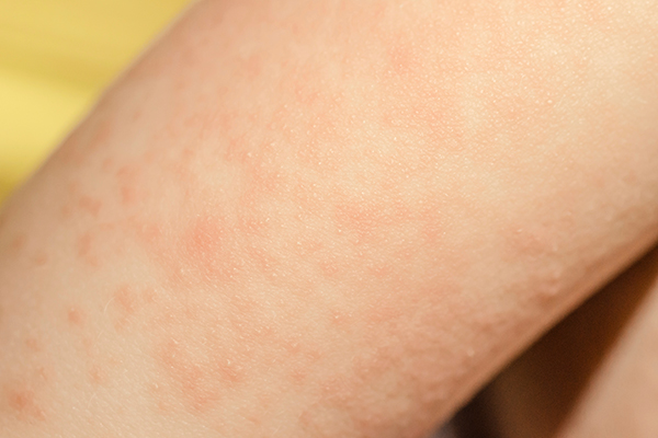 skin rash from tramadol